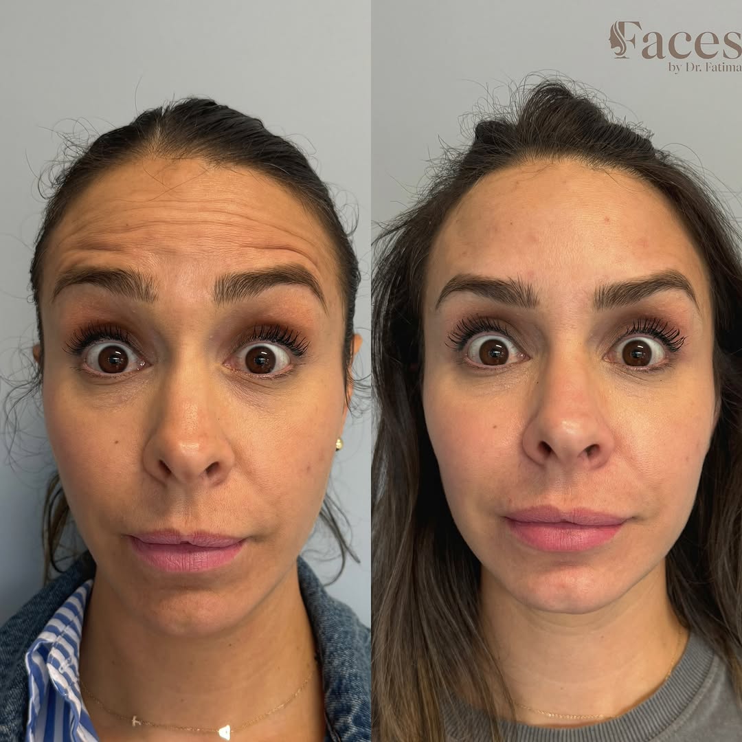 Botox before and after for forehead lines, by Dr. Fatima Mahdi in Alliston
