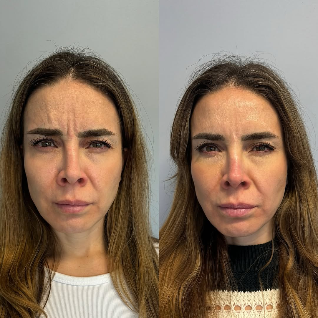 Botox before and after for frown lines, by Dr. Fatima Mahdi in Alliston