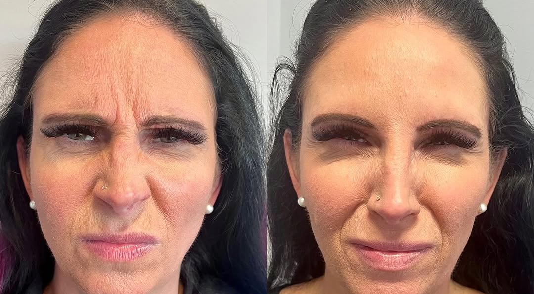 Botox before and after for frown lines, by Dr. Fatima Mahdi in Alliston