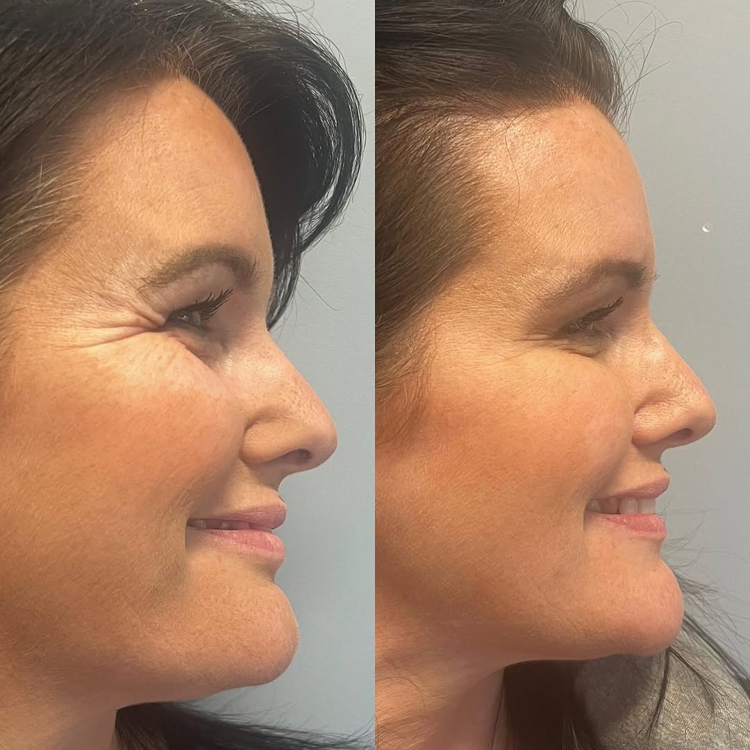 Botox before and after around the eyes, by Dr. Fatima Mahdi in Alliston