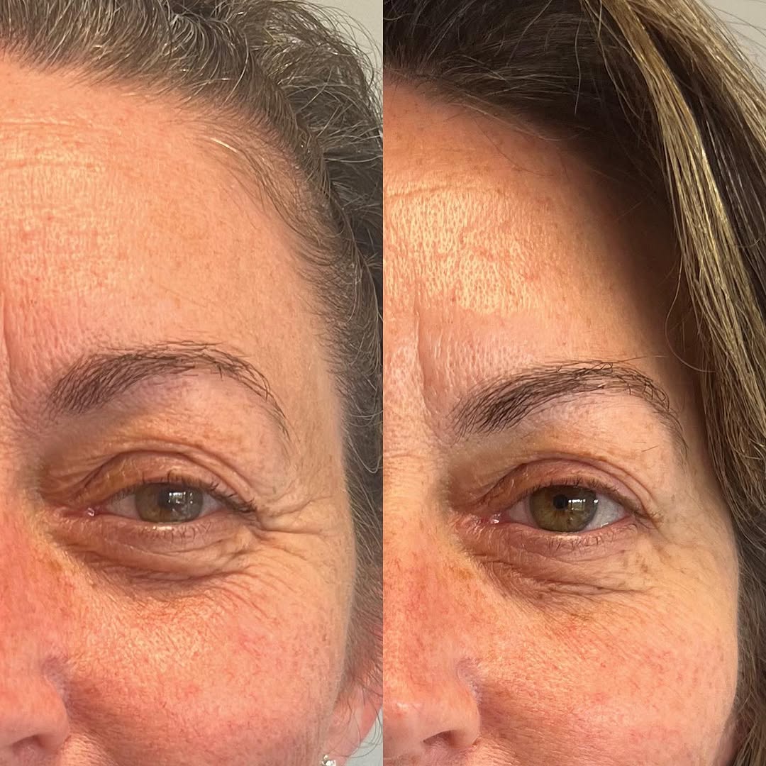 Botox before and after for crow's feet, by Dr. Fatima Mahdi in Alliston