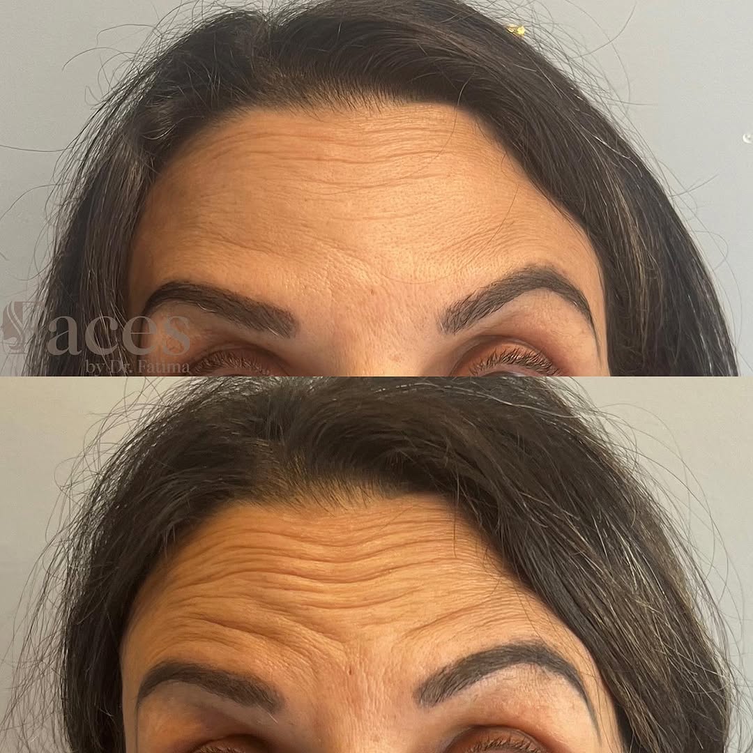 Botox before and after for forehead lines, by Dr. Fatima Mahdi in Alliston