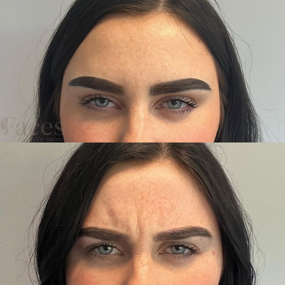 Botox before and after for frown lines, by Dr. Fatima Mahdi in Alliston